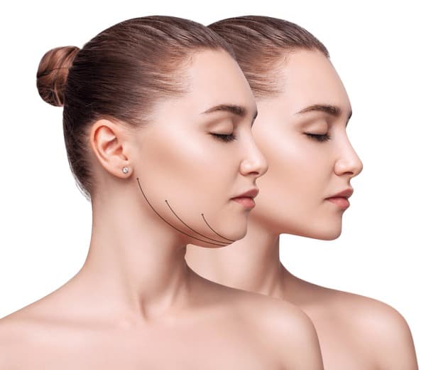 Double Chin Suction cost in Iran 