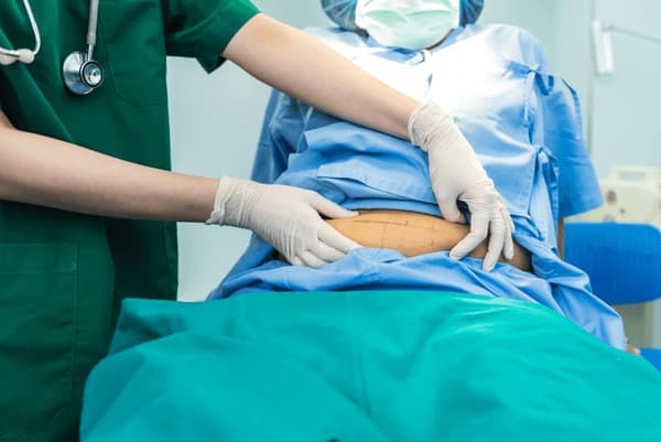 Coolsculpting vs. Liposuction