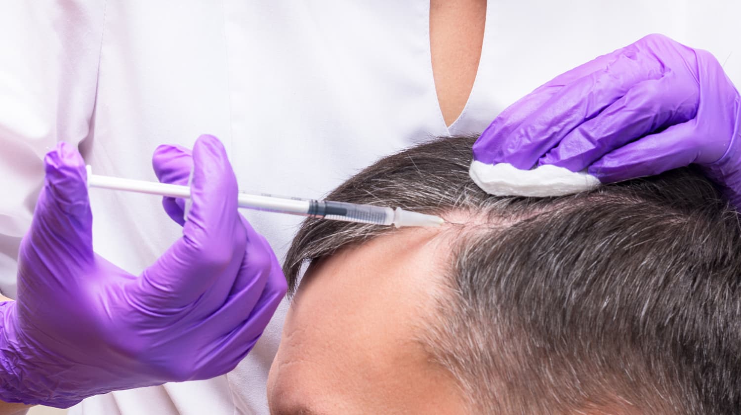 Risks of Hair Filler Injections
