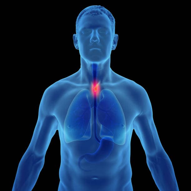 Esophagectomy cost in Iran