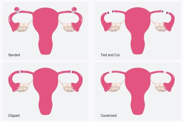 What is post-tubal ligation syndrome?
