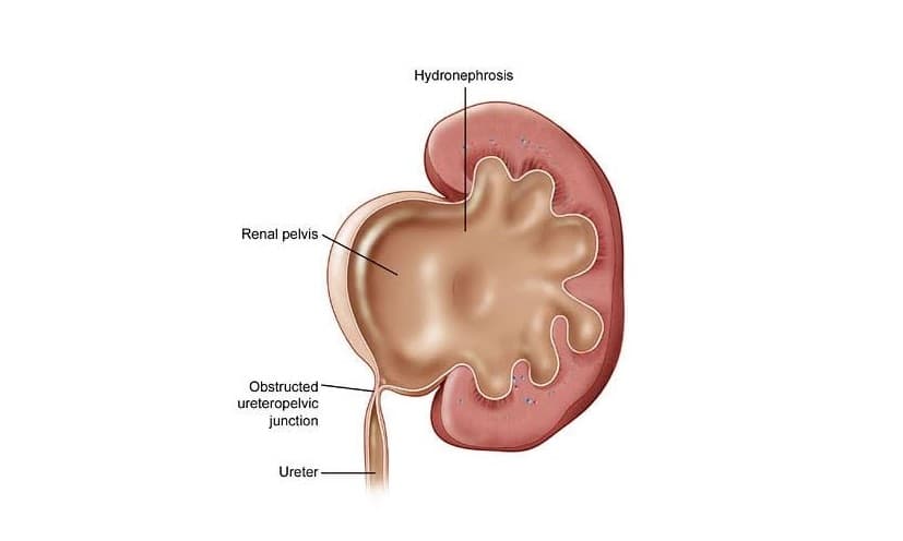 How to prepare for Pyeloplasty?