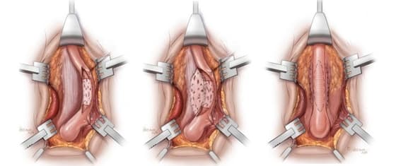 What are the different types of Urethral surgery?