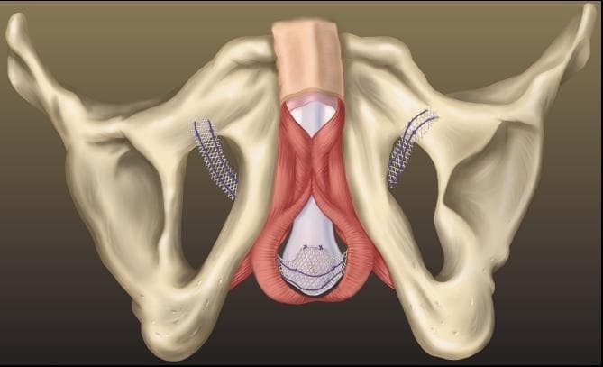How does the Urethral get damaged?