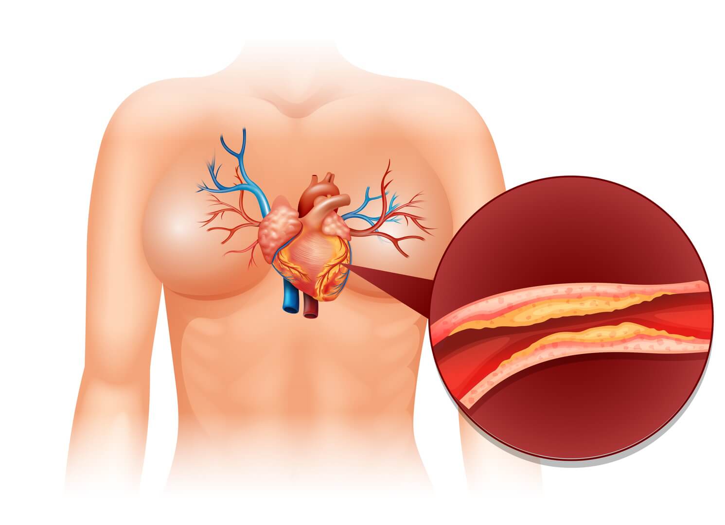 What is Angiography?