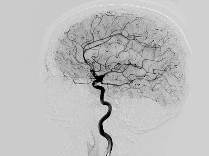 Who needs an Angiography?