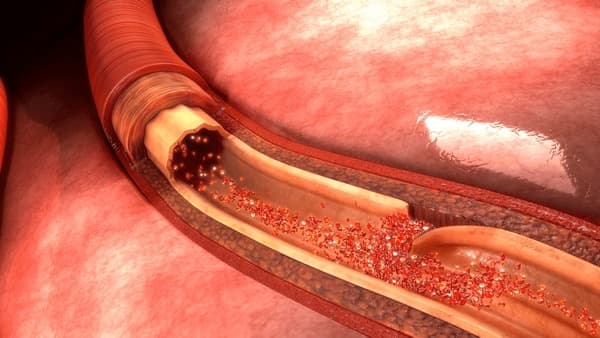 Types of Aortic Surgery