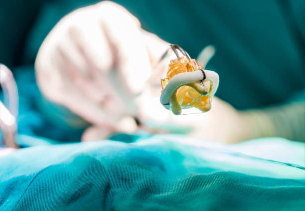 Aortic Surgery cost in Iran
