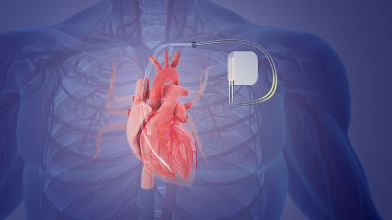Pacemaker 