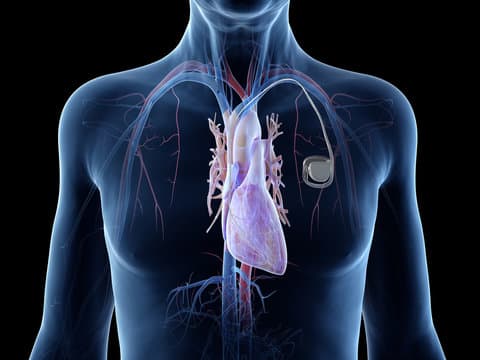 What are the different types of pacemakers?