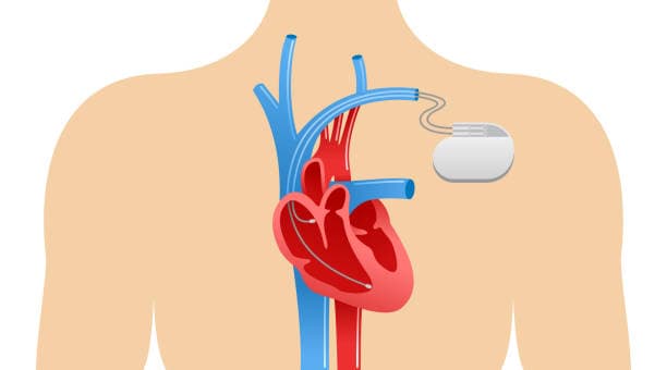 Pacemaker surgery recovery