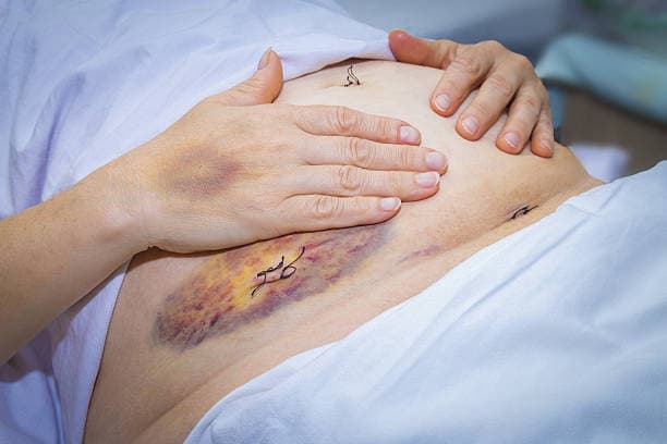 How to get ready for an Appendectomy