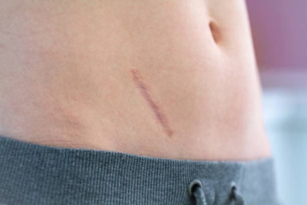 What are the risks of Appendectomy?