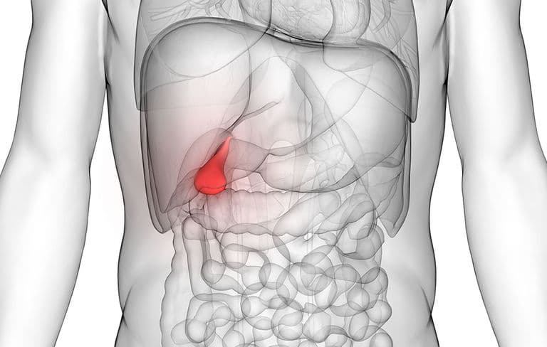 Cholecystectomy