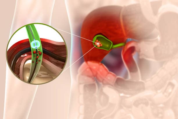 What is a Cholecystectomy?