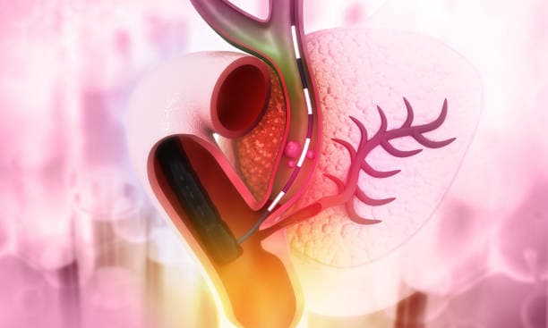 Cholecystectomy