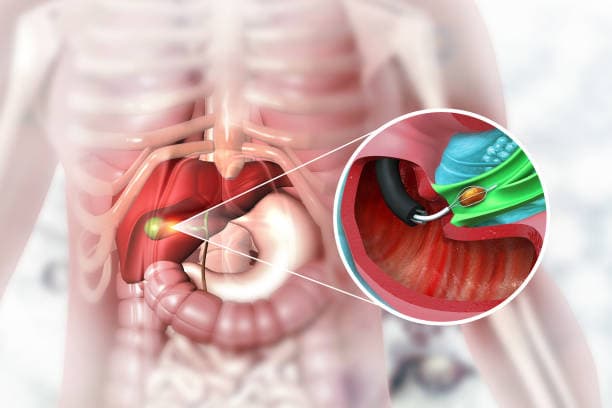 Cholecystectomy risks