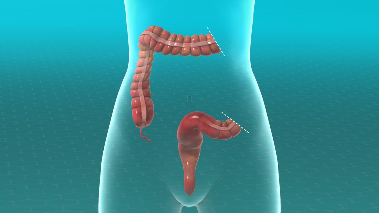 Colectomy 