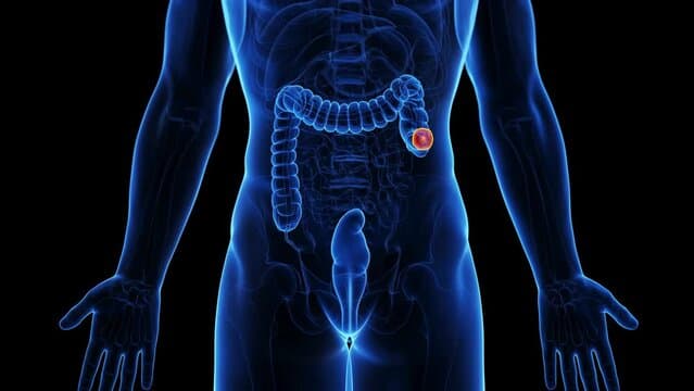What is a Colectomy?