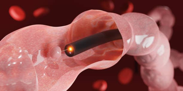 Colectomy risks