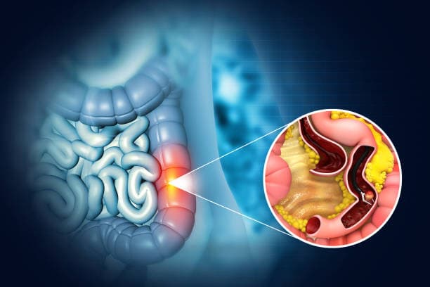 Colectomy benefits