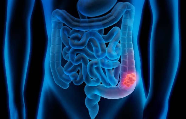 Colectomy recovery