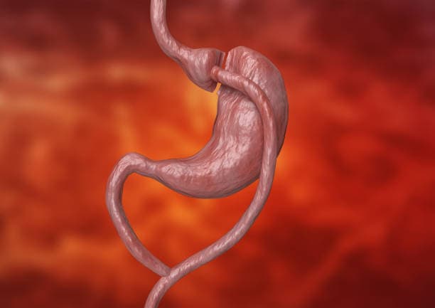 What does Gastrectomy treat?