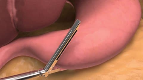 How to prepare for Gastrectomy?