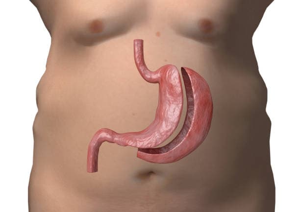 Gastrectomy risks