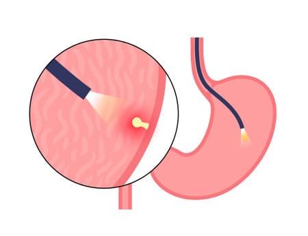 Gastrectomy recovery