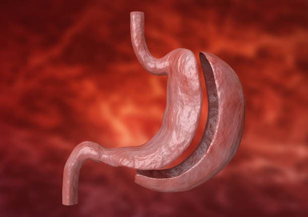 Gastrectomy cost in Iran
