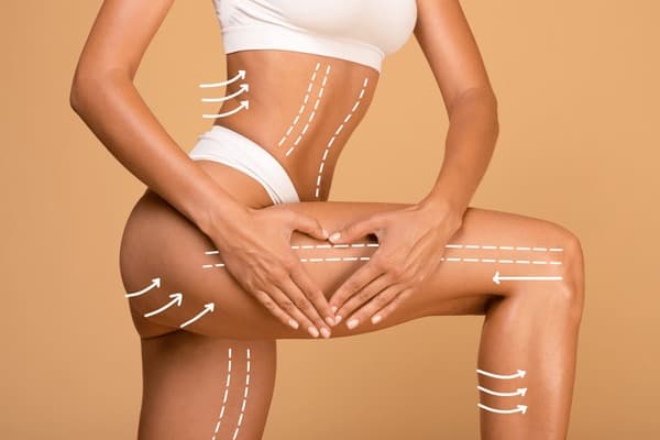 How long does body lift recovery take?