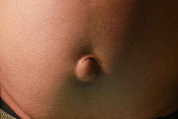 Hernia Repair cost in Iran