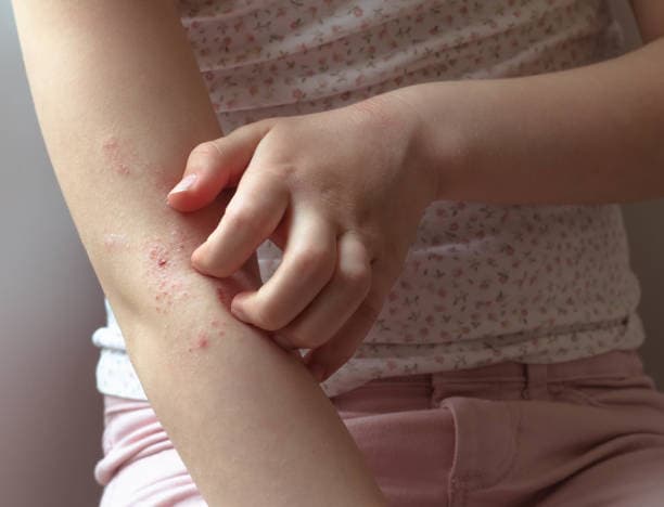 How is Eczema treated?