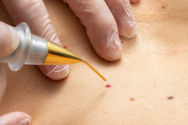 What are the types of Warts?