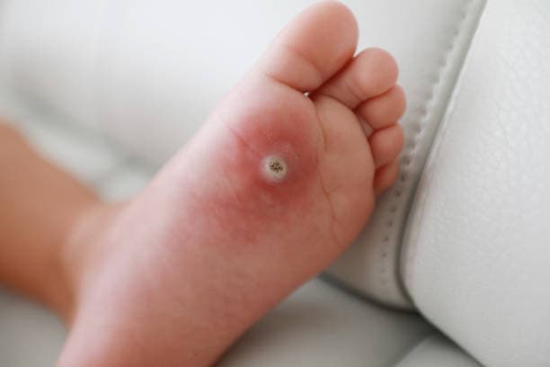What parts of the body do Warts affect?