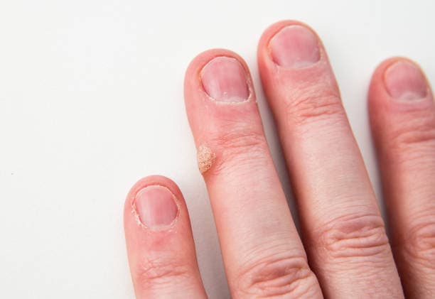How are Warts treated?
