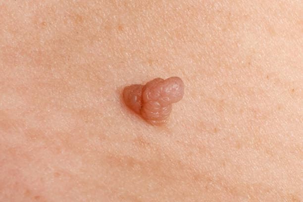 Warts Treatment cost in Iran