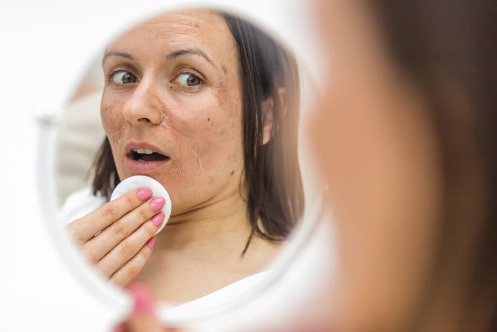 What are the Brown Spots on skin?
