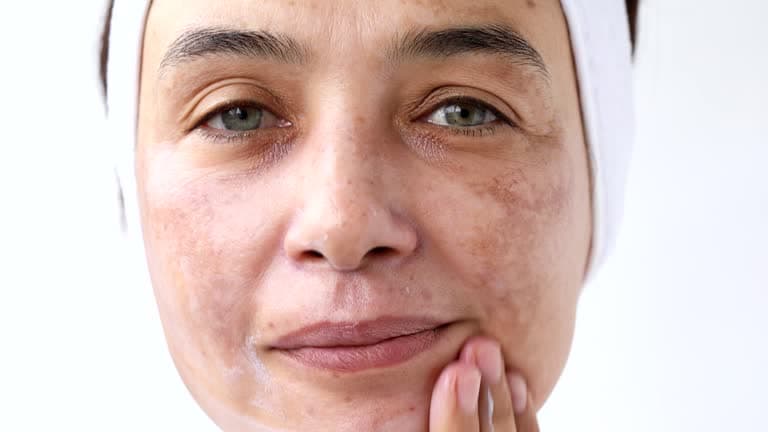 Who is at risk of melasma?