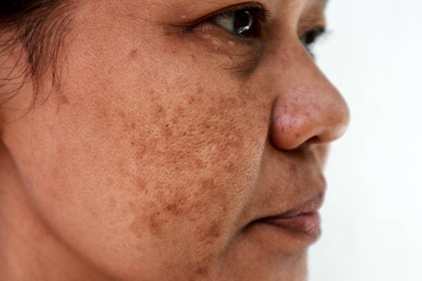 What are the signs of melasma?