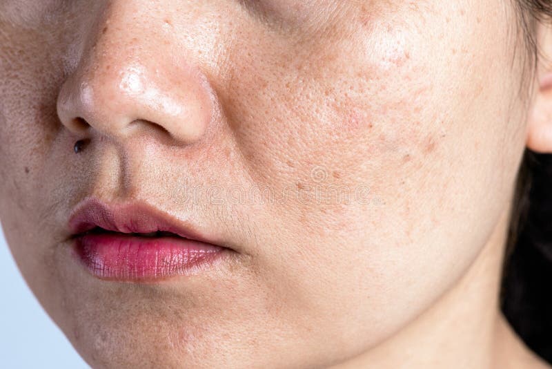 How is Melasma diagnosed?