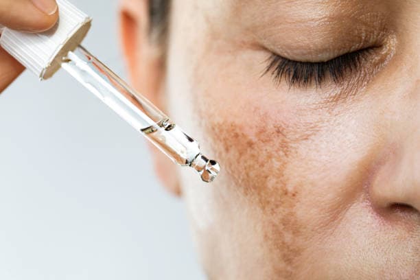 Melasma Treatment cost in Iran