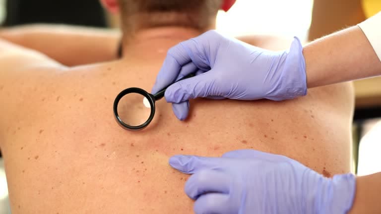 Hemangioma Treatment 