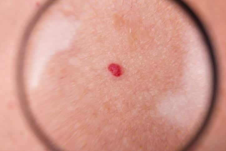 What are red birthmarks called?