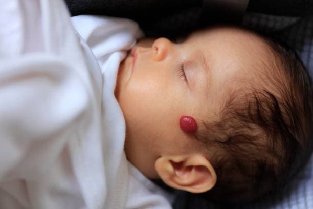 Who do hemangiomas affect?