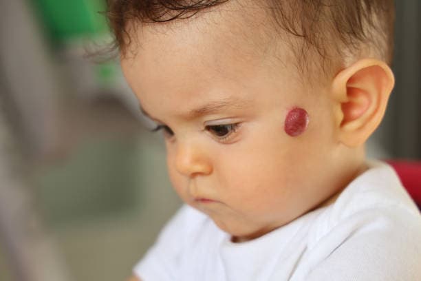 What causes hemangiomas?