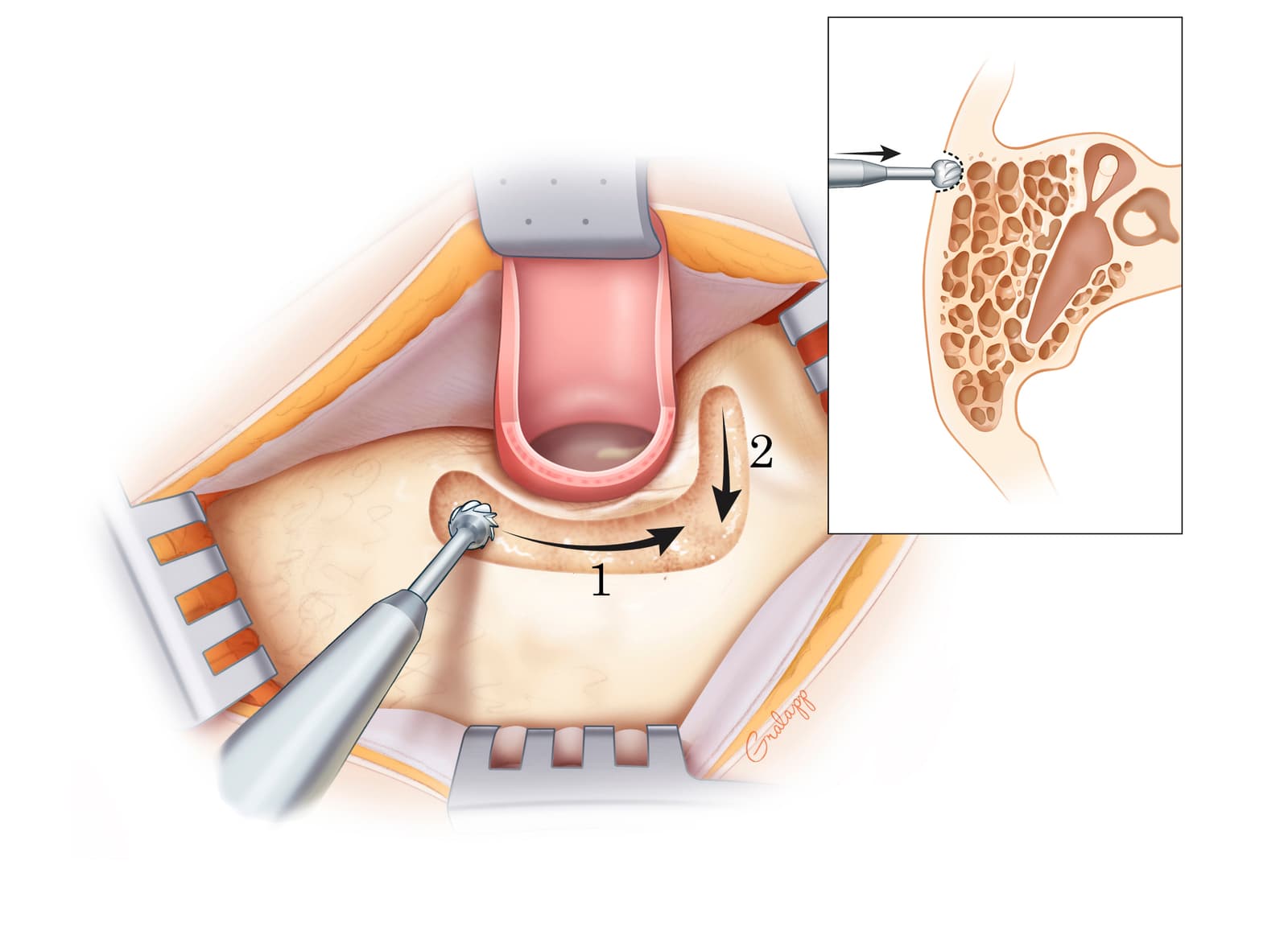Mastoidectomy