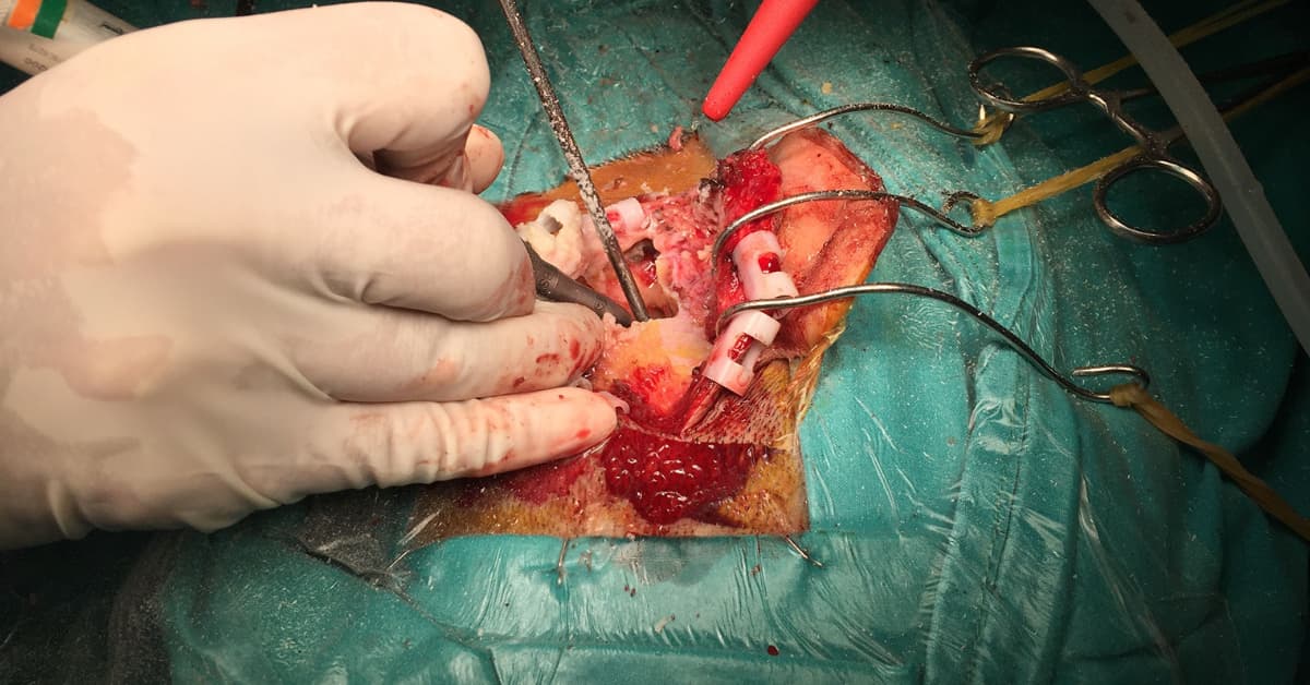 What is a mastoidectomy?