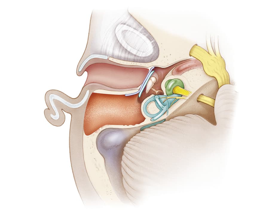 Mastoidectomy disadvantages